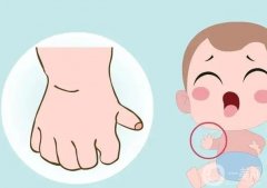 手指畸形有哪些類型？