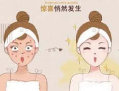 做激光后的注意事項有哪些呢？