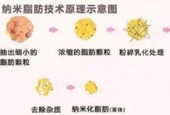 什么是納米脂肪填充？有哪些作用
