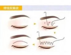 埋線雙眼皮果的維持時間受哪些因素影響？疤痕太怎么辦？