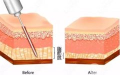 水動力吸脂價格的影響因素有哪些？有什么副作用？