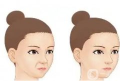 哪些因素影響玻尿酸填充法令紋的價格？法令紋填充后需要注意什么？