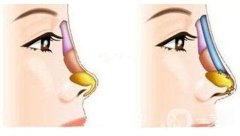 鞍鼻整形貴嗎，價(jià)格是多少?