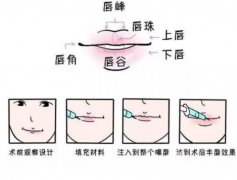 玻尿酸豐唇的優(yōu)點(diǎn)是什么，果如何？