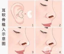 耳軟骨墊鼻尖有什么副作用和后遺癥？