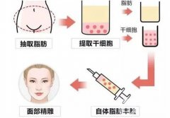 如何處理自體脂肪填充后的硬結(jié)？有什么風(fēng)險(xiǎn)？