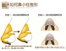 玻尿酸可以注射鼻小柱嗎？鼻小柱延長有哪些常用方法