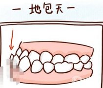 地包天能矯正好嗎？地包天是怎么形成的？