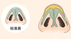 鼻頭縮小手術(shù)的優(yōu)點和缺點是什么？