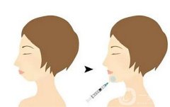 玻尿酸注射下巴可以維持多久？有什么危害？會變寬嗎？