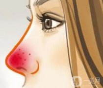 酒渣鼻怎么調(diào)節(jié)好？酒渣鼻能治好嗎？