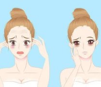 填充法令紋可以用哪些玻尿酸？