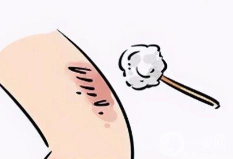 激光祛疤術(shù)后護(hù)理