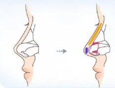 鼻小柱延長(zhǎng)后會(huì)不會(huì)塌陷？哪些人群適合鼻小柱延長(zhǎng)術(shù)？