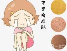 激光可以去除雞皮嗎？雞皮去除有哪些注意事項(xiàng)