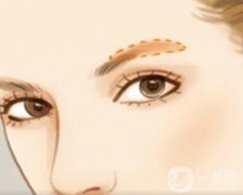 眉弓微整的優(yōu)缺點(diǎn)？眉弓微整前有哪些準(zhǔn)備？