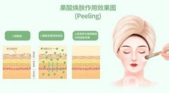 果酸換膚有哪些術(shù)前準(zhǔn)備？術(shù)后如何護(hù)理？
