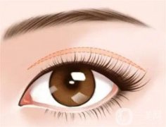 開(kāi)眼角的恢復(fù)時(shí)間如何縮短？開(kāi)眼角后拆線疼嗎？