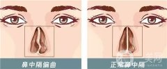 鼻中隔偏曲的危害是什么？手術的風險有哪些