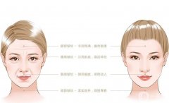 射頻緊膚有沒有果？適合什么人？