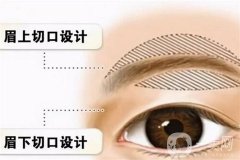 切眉術(shù)后的注意事項？應該怎么護理