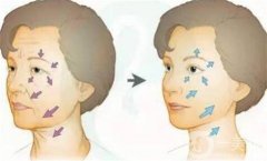 全臉脂肪填充怎么樣？優(yōu)勢有哪些？哪些人又不能做呢