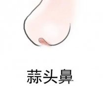 怎么矯正大蒜鼻？如何不手術(shù)改良大蒜鼻？