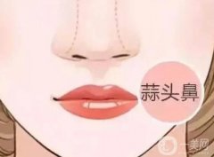 大蒜鼻整形有后遺癥嗎？恢復(fù)自然需要多長(zhǎng)時(shí)間？