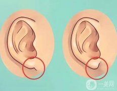 豐耳垂的方法有哪些？