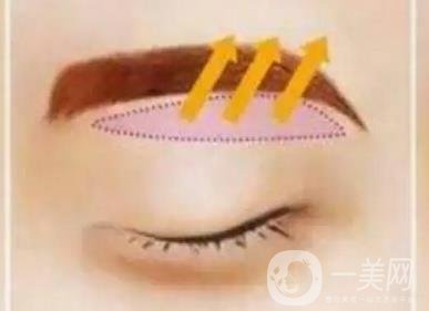 上海假體豐眉弓價格 豐眉弓材料有哪些