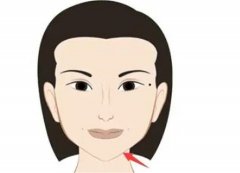 墊下巴的果是*的嗎？多長時(shí)間可以消腫