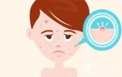 激光調(diào)節(jié)痤瘡有副作用嗎？