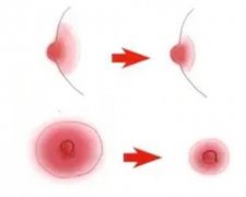 乳暈縮小術(shù)的方法？對(duì)母乳喂養(yǎng)有影響嗎？