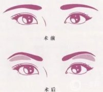 切眉后眼睛變形了怎么辦？浮腫怎么辦？