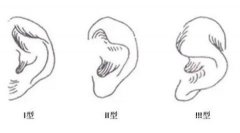 怎么切除副耳?副耳切除有危險(xiǎn)嗎?