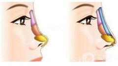 為什么耳軟骨墊鼻尖會(huì)歪斜？耳軟骨墊鼻尖后歪斜怎么辦？
