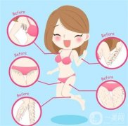 超冰點(diǎn)脫毛的副作用有哪些？