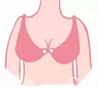 假體隆胸失敗有什么癥狀？隆胸后需要臥床多久？