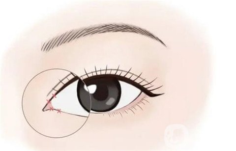 開眼角的危害是什么？如何開眼角的*