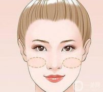 蘋果肌凹陷怎么處理？蘋果肌在哪里？