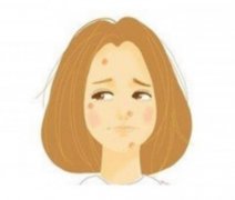 痘印可以用去除嗎？做完后需要加強防曬嗎？