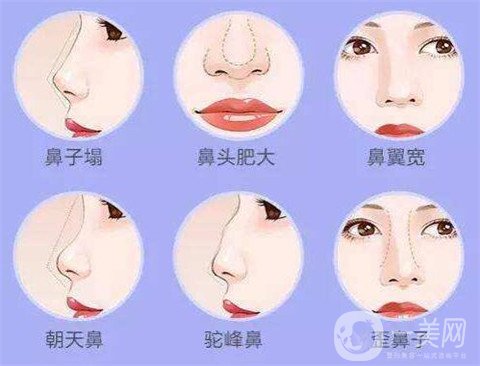 湖南省人民醫(yī)院整形美容科隆鼻*果如何？看價格表及案例實述