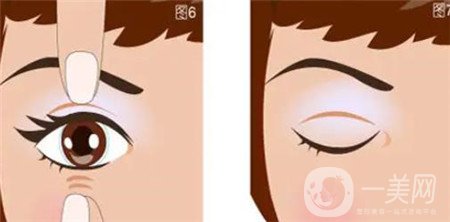 山東省立醫(yī)院開眼角多少錢?附2020整形價(jià)格表及案例