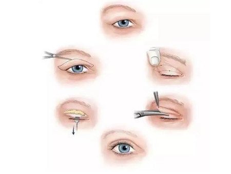 山東省立醫(yī)院開眼角多少錢?附2020整形價(jià)格表及案例