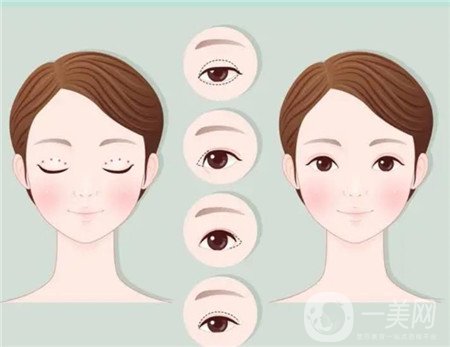 咸陽二院美容科雙眼皮多少錢?案例及價(jià)格表一覽