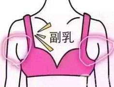副乳切除術(shù)后恢復(fù)時間和飲食注意解答