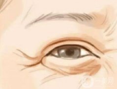 激光去除魚尾紋果如何？有什么副作用嗎