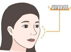 下頜角截骨術(shù)有哪些特點(diǎn)和風(fēng)險(xiǎn)？適合哪個(gè)年齡？