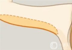 什么因素決定手臂吸脂的價(jià)格？