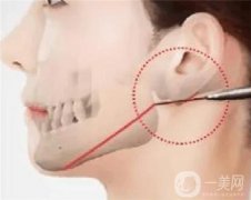 為什么下頜角不好看？介紹五種類型看看你是不是